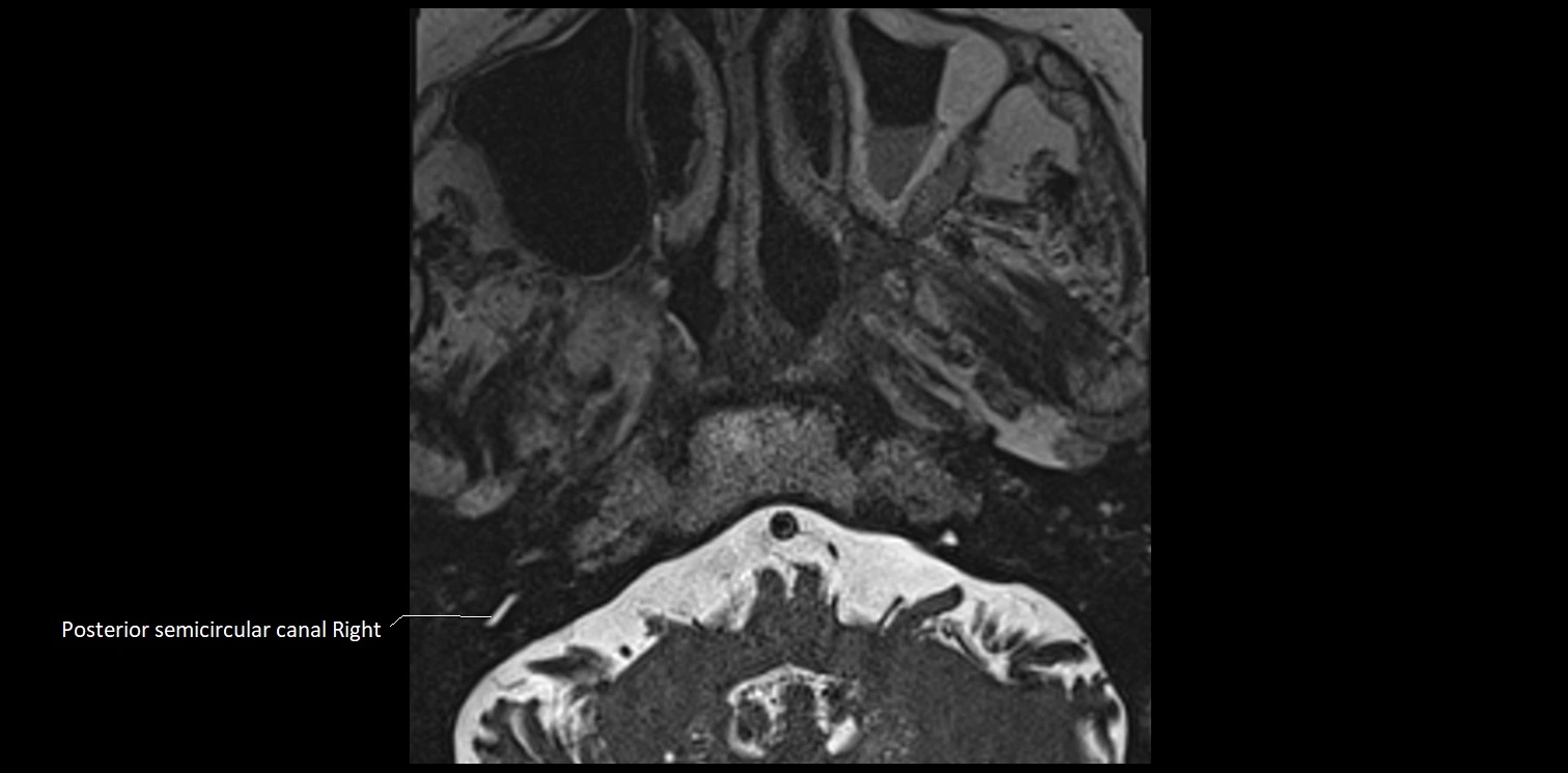 Cranial nerve anatomy axial MRI 3T image 64.webp